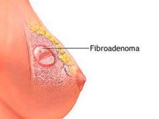 фиброаденома груди